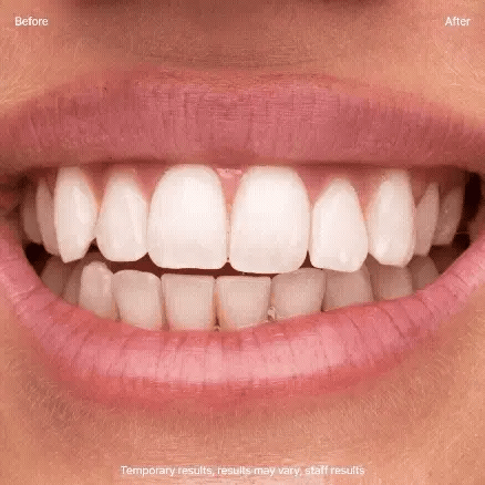 MiChae™ (미채)- Korean Teeth Whitening Strips Kit [28 pcs in 1 pack]